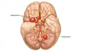 Emorragia cerebrale E dovuta alla rottura di un vaso cerebrale a cui consegue la fuoriuscita del sangue che invade e danneggia il tessuto cerebrale.