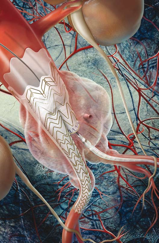 Arteria renale sinistra Aorta addominale Rene sinistro Filo guida Ancoraggio (uncini metallici) Tronco dell'endoprotesi GORE EXCLUDER AAA Aneurisma in fase di esclusione (isolamento) Arteria iliaca