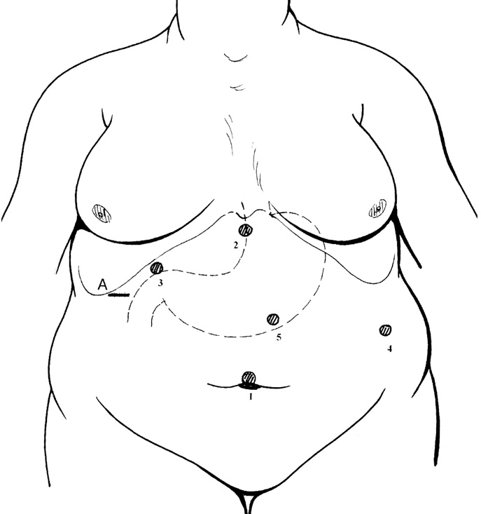 Fig. 8: Gastroplastica verticale laparoscopica.
