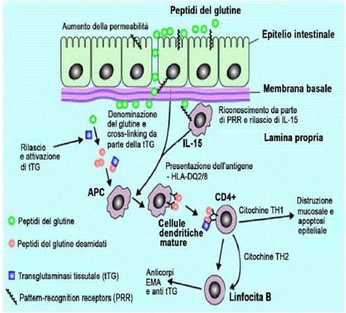 Figura 1 Patogenesi della celiachia. Il glutine, giungendo nella lamina propria, viene deamidato dalla ttg con conseguente formazione degli antigeni gliadinici.