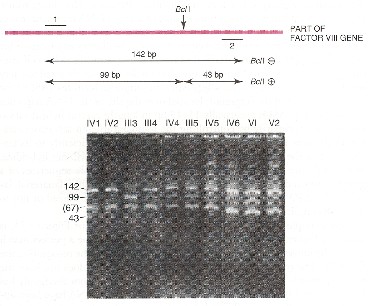Parte degli individui di questa famiglia sono stati sottoposti ad analisi di un RFLP (sito per Bcl I) presente in un introne del gene (vedi foto gel di seguito).