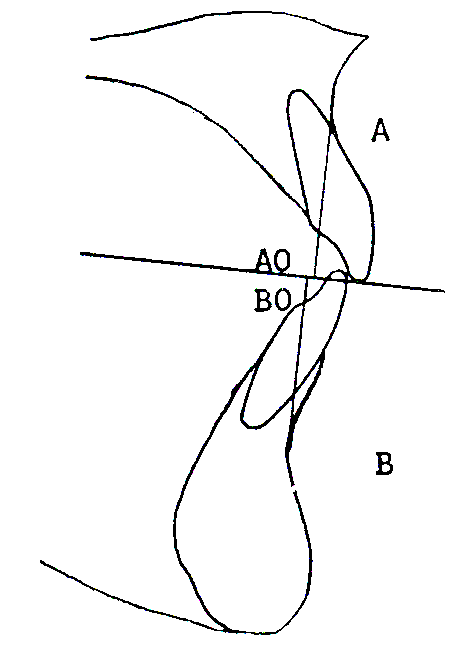 Non solo lo spostamento sul piano sagittale del punto nasion (vale a dire una base cranica anteriore lunga o corta), può influenzare la veridicità dell angolo ANB, ma anche uno spostamento su un