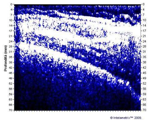 COSCIA (STRATIGRAFIA) Stratigrafia Spessore del grasso superficiale all interno dei valori attesi per sesso ed età per quanto riguarda spessore, conformazione e distribuzione.