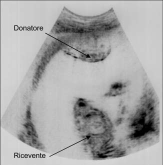 Figura 3. Sindrome da trasfusione gemello-gemello di grado severo a 20 settimane di gravidanza.