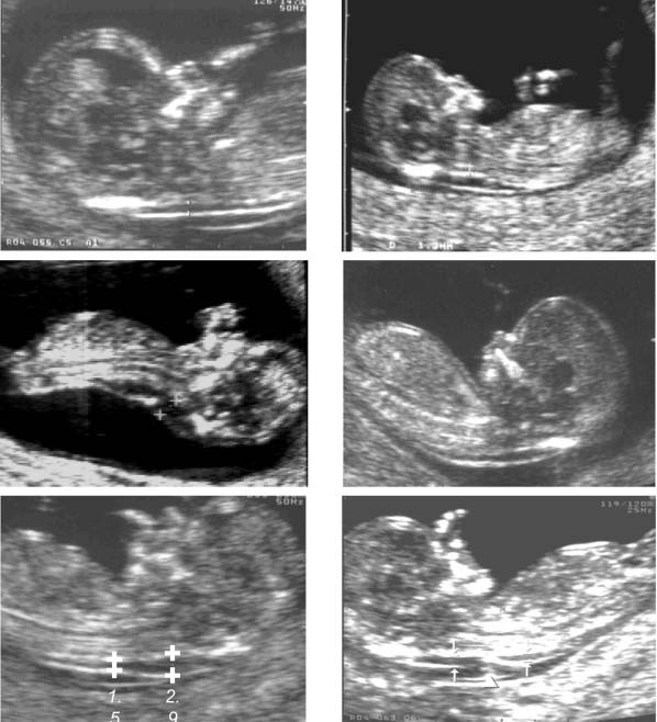 (a) (b) (c) (d) (e) (f) Figura 8. Immagini ecografiche di feti a 12 settimane di gravidanza. In tutte le sei immagini è stata ottenuta una buona sezione sagittale del feto.