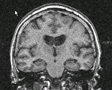 2) Uno specifico profilo di atrofia del lobo temporale mediale visibile con MRI o TC Atrofia in Alzheimer s disease AD Prodromica 15%