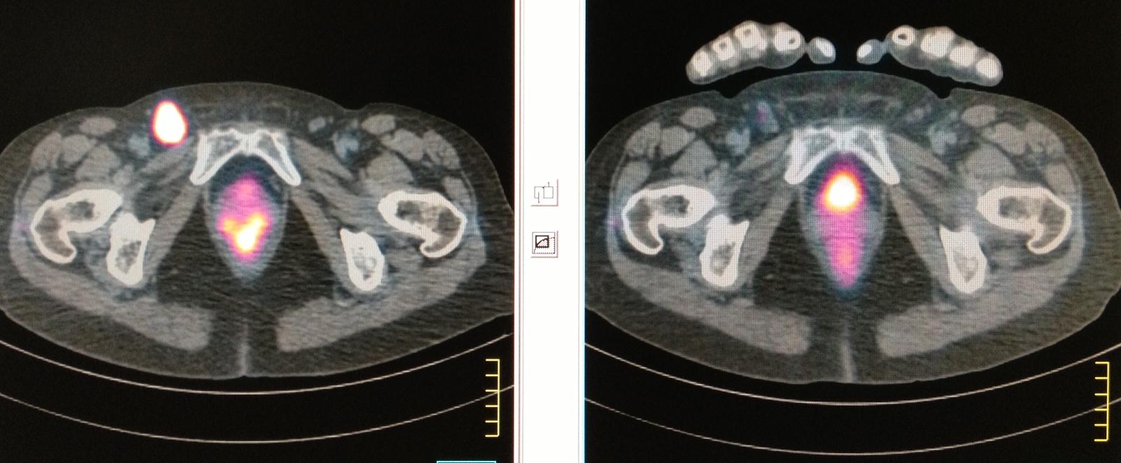 PET-CT scan before Imatinib