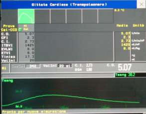 PiCCO (Pulse Continuos Cardiac Output) Calibrazione del sistema principio della termodiluizione Si inietta il più