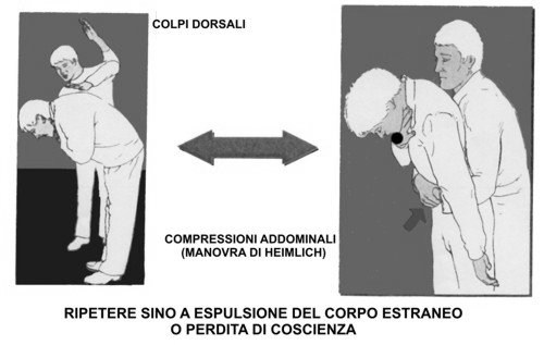 OSTRUZIONE DELLE VIE AEREE DA CORPO ESTRANEO - Si possono distinguere: 1. ostruzione parziale: la vittima respira con difficoltà, si sentono dei sibili, riesce a tossire 2.