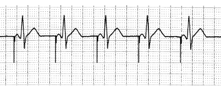 A Pace / V Sense Atrial Pacing with Normal A V Conduction