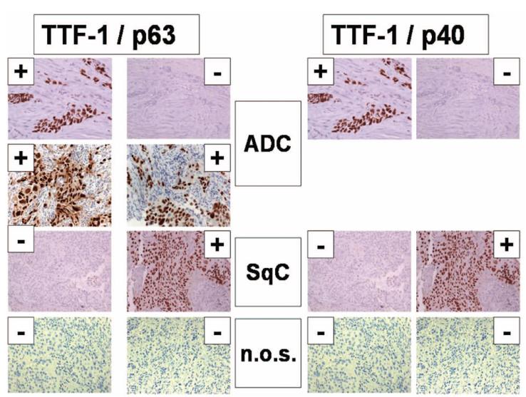 I s t o l o g i a ( 1 ) Carcinoma squamoso vs Carcinoma a piccole cellule p63/p40 +++/+++ (~100%) / TTF-I ++ (~80%) Cromogranina ++ (dot-like) Carcinoma squamoso vs Adenocarcinoma p63/p40 +++/+++