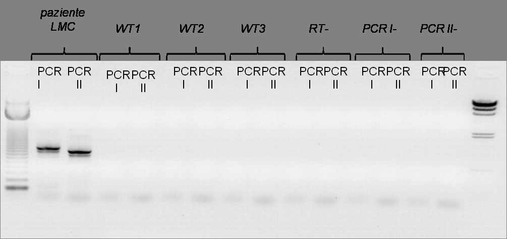 Figura 4. La semi-nested PCR ha evidenziato la presenza di un trascritto di fusione nel paziente in esame utilizzando i primers reverse per HOXA13.