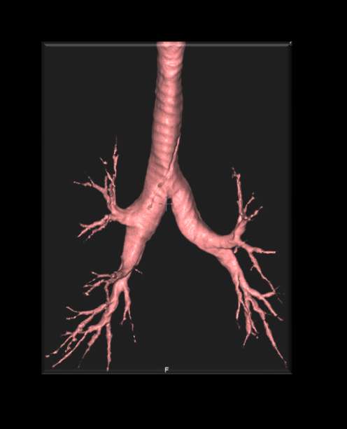 CT scan in COPD Quantitative