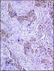 Geni e neoplasie della mammella Nella patogenesi del cancro della