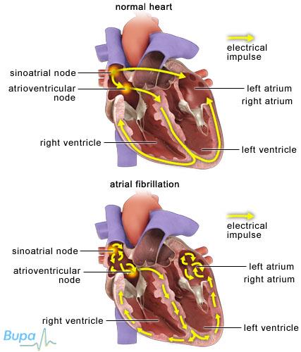 ATRIAL FIBRILLATION Atrial fibrillation (AF) is an abnormal heart rhythm characterized by