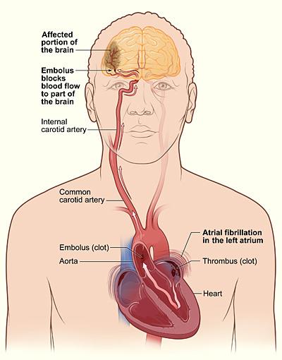 AFIB: A COMMON BUT SERIOUS ARRYTHMIA AFib increases the risk of stroke 5-fold 1 particularly in the elderly, similarly for paroxysmal, persistent and permanent AFib 2 Strokes associated with AFib are