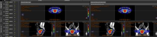 Funzioni radiobiologiche esempi v i : is the fractional organ volume receiving a dose D i a: a tissue-specific parameter that describes the volume effect.