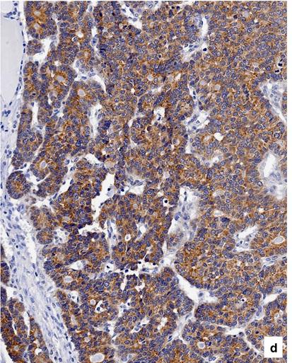 Aree di proliferazione cellulare associate ad aree di necrosi(a, 10), elevato indice mitotico(b,