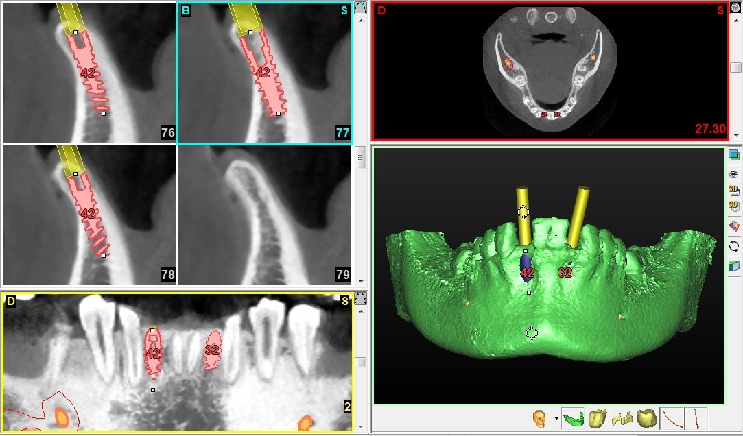 cro le radiazioni alle mascelle, il fumo, l'alcolismo, o una parodontopatia avanzata, che possono impedire l integrazione dell impianto con l osso (osteointegrazione).