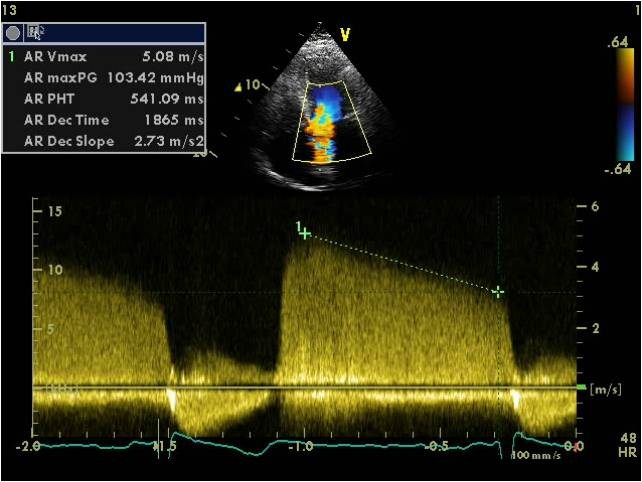 Qualità del segnale Doppler (denso,