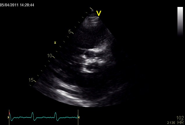 VALVOLA AORTICA Anomalie acquisite