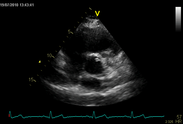 VALVOLA AORTICA Valore