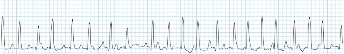 Modificazioni ecgrafiche in corso di COPD Alterazioni del ritmo Extrasistolia