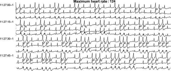 Tossicità cardiaca QT lungo Dasatinib + Nilotinib QT lungo + TKI o senza predisposizione Sospendere TKI se QTc >