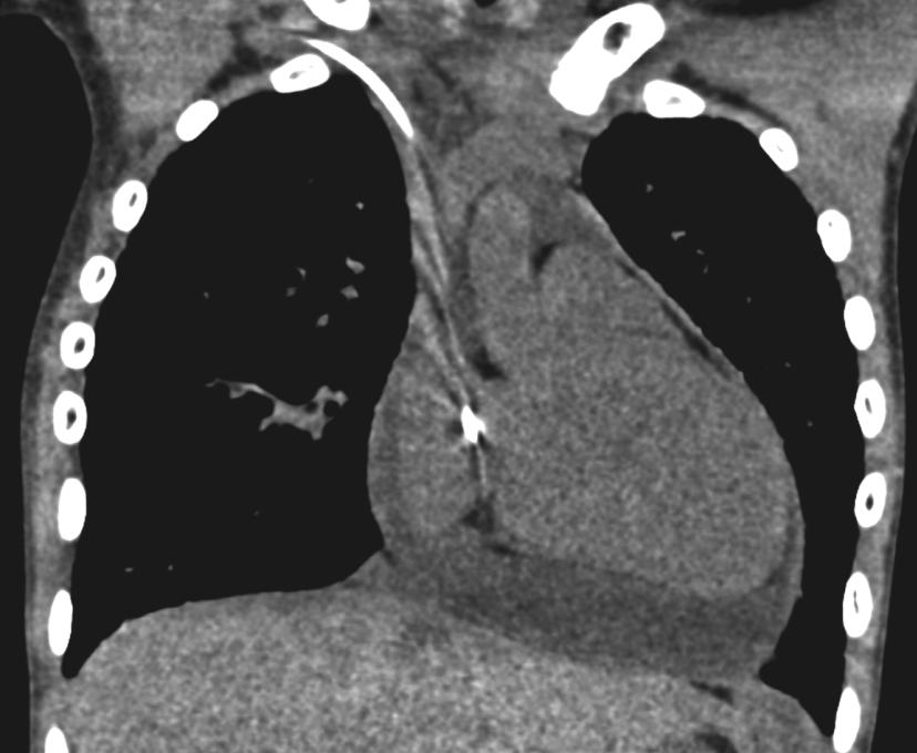 Nuovo peggioramento clinico Alcune settimane dopo: Peggioramento clinico e