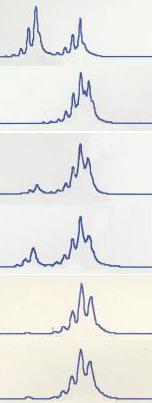 STR CHIMERISMO Patient Donor Mixed chimerism at +30 (PB) Mixed chimerism