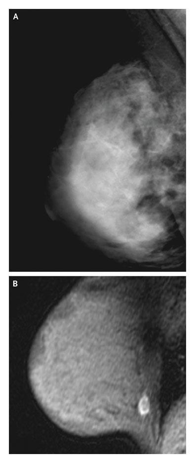 Mammographically Occult Breast Cancer Detected in the Carrier of a BRCA2