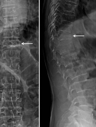 Scenario 7: Una donna di 62 anni presenta dorso-lombalgia da oltre un mese e porta in visione la seguente radiografia. Domanda #9 (codice domanda: n.299) - (riferita allo scenario n.