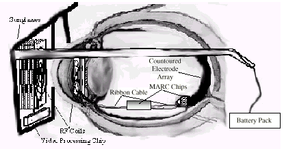 9,,,3527(6,(3,5(7,$/, 8QD SURWHVL HSLUHWLQDOH q XQ GLVSRVLWLYR FRQ FXL VL FHUFD GL ULSULVWLQDUH OD IXQ]LRQH YLVLYD DWWUDYHUVR OD