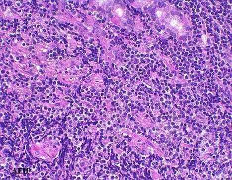 Classifichiamo un tumore 2 carcinoma squamoso adenocarcinoma in