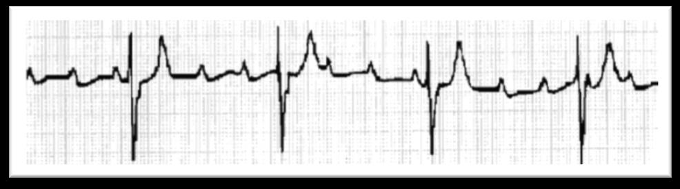 blocco 2:1 presenta due onde P per un complesso QRS, con frequenza ventricolare 60 bpm e frequenza atriale 110 bpm (Figura 1.16)