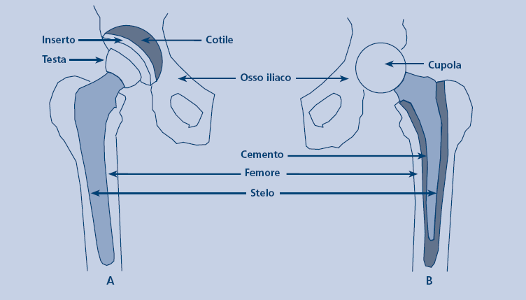 Schema di protesi d anca (metallo o ceramica):