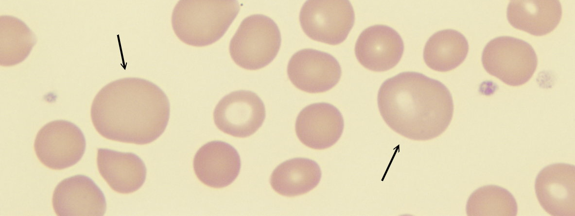 Emocromo < Leucociti 4,40 10^9/L Eritrociti 4,12 10^12/L < Emoglobina 116 g/l Ematocrito 0,37 L/L > MCV 100,0 fl > MCH 33,1 pg MCHC 331 g/l > RDW 17,1 % < Piastrine 146 10^9/L MPV 9,9 fl Emocromo: