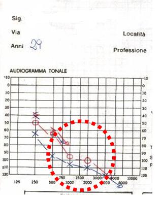 Classificazione audiometrica dei deficit uditivi (BIAP 1997) www.biap.org/ reperibile in italiano: www.arcipelagosordita.it/raccomandazioni-biap-03.