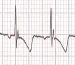Variante Normale complesso QRS in V1 Rr