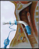 La cannula tracheale cannula