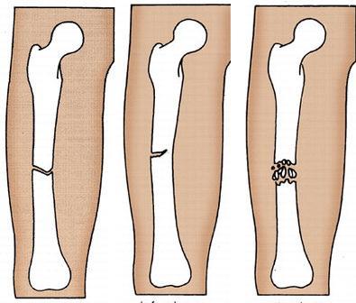 Fratture La frattura è l interruzione della continuità di un osso.