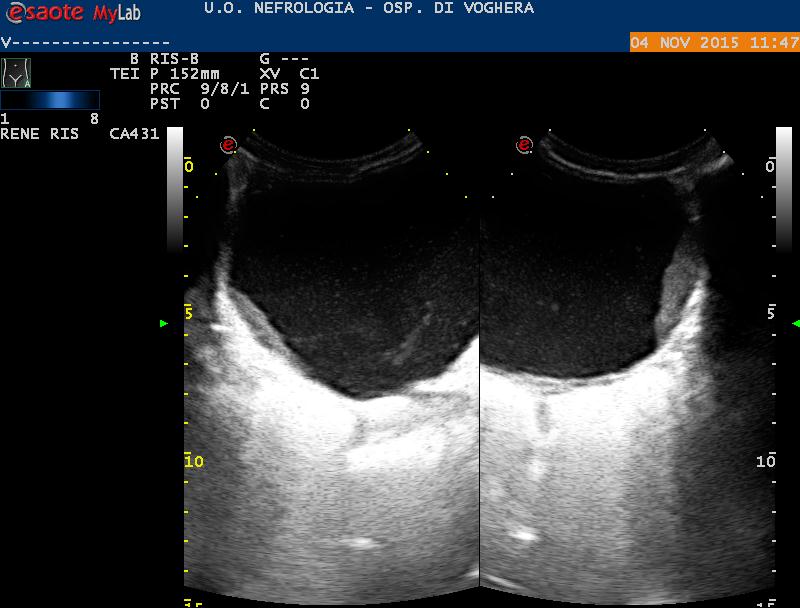 In condizioni patologiche : Urina corpuscolata: in corso di patologia infiammatoria o ematuria.