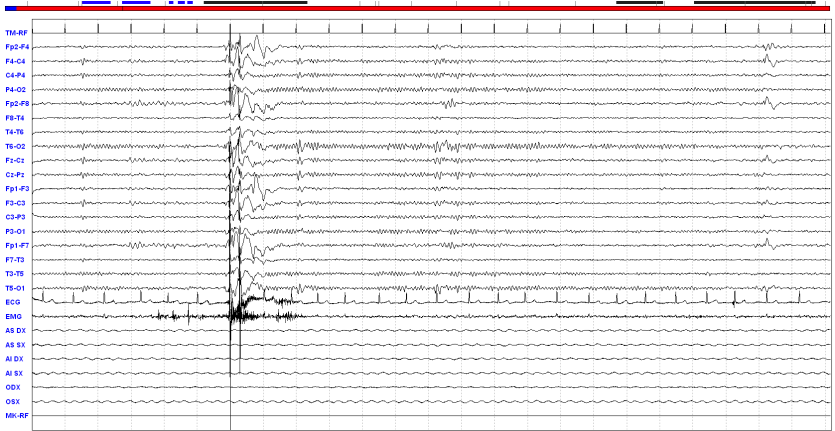 EEG: epilessia