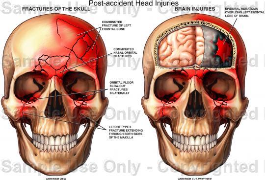 Con trauma cranico si intende una qualsiasi lesione al cranio o al