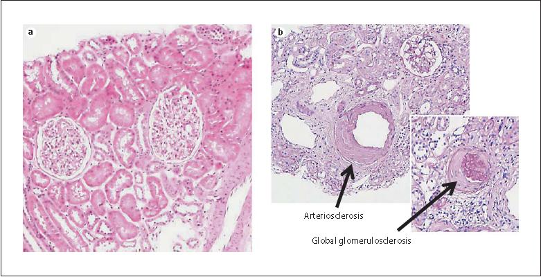 20-yr kidney donnor