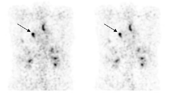 124 I PET/CT: UTILIZZO PER LA DIAGNOSTICA E LA DOSIMETRIA NEL CARCINOMA TIROIDEO PET images of a patient with metastatic thyroid cancer at 24 h after administration of 37 MBq 124I acquired on a