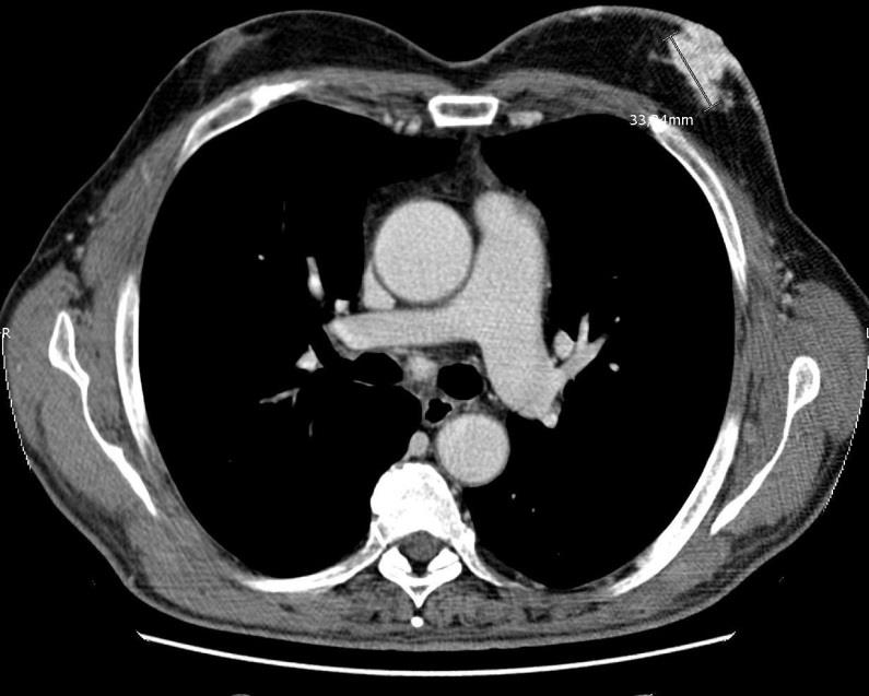 In terapia con LENVATINIB 30x30 mm 20x21 mm Metastasi mediastinica paratracheale dx