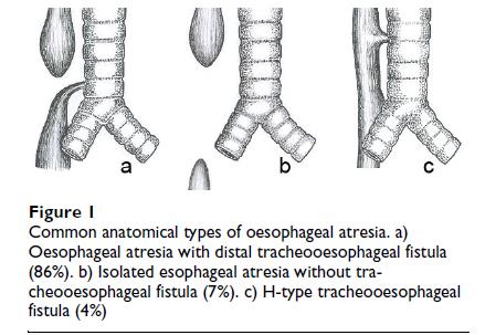 Atresia Esofagea Assente comunicazione tra esofago prossimale, distale e stomaco per mancato sviluppo della porzione intermedia dell esofago (85%) fistola tracheo esofagea 1:2500-4500 nati vivi