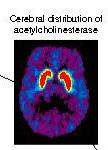 DSA Discalculia Evolutiva (OMS) disturbo a patogenesi organica,