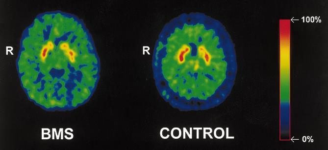 .. with dopamine D1 and D2 receptor radioligands, PET imaging has revealed alterated binding to striatal D1 and D2 receptors in